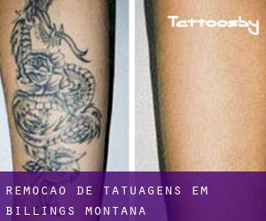 Remoção de tatuagens em Billings (Montana)