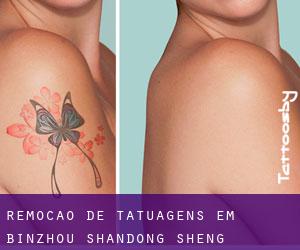 Remoção de tatuagens em Binzhou (Shandong Sheng)