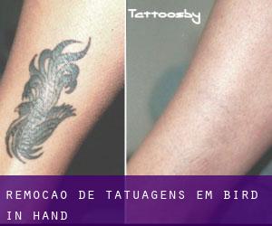 Remoção de tatuagens em Bird in Hand