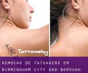 Remoção de tatuagens em Birmingham (City and Borough)