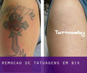 Remoção de tatuagens em Bix