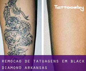 Remoção de tatuagens em Black Diamond (Arkansas)