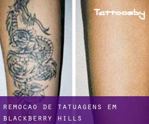Remoção de tatuagens em Blackberry Hills
