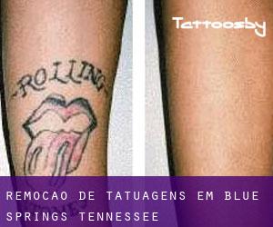 Remoção de tatuagens em Blue Springs (Tennessee)