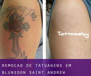 Remoção de tatuagens em Blunsdon Saint Andrew