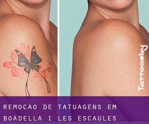 Remoção de tatuagens em Boadella i les Escaules