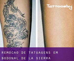 Remoção de tatuagens em Bodonal de la Sierra