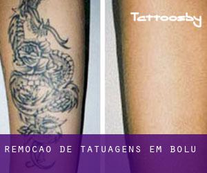 Remoção de tatuagens em Bolu