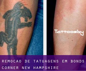 Remoção de tatuagens em Bonds Corner (New Hampshire)