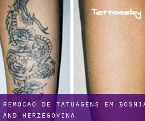 Remoção de tatuagens em Bosnia and Herzegovina