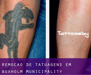 Remoção de tatuagens em Boxholm Municipality