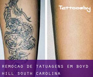 Remoção de tatuagens em Boyd Hill (South Carolina)