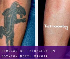 Remoção de tatuagens em Boynton (North Dakota)