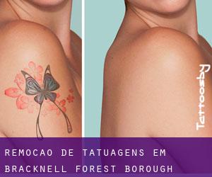 Remoção de tatuagens em Bracknell Forest (Borough)