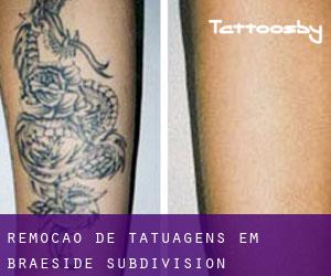 Remoção de tatuagens em Braeside Subdivision