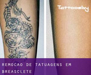 Remoção de tatuagens em Breasclete