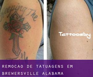 Remoção de tatuagens em Brewersville (Alabama)
