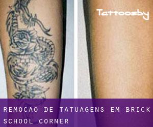 Remoção de tatuagens em Brick School Corner