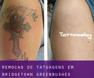 Remoção de tatuagens em Bridgetown-Greenbushes