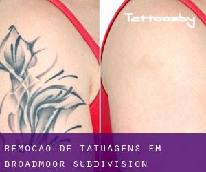 Remoção de tatuagens em Broadmoor Subdivision