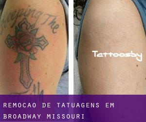 Remoção de tatuagens em Broadway (Missouri)