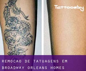 Remoção de tatuagens em Broadway-Orleans Homes