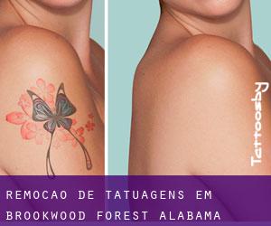Remoção de tatuagens em Brookwood Forest (Alabama)