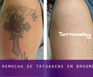 Remoção de tatuagens em Broome