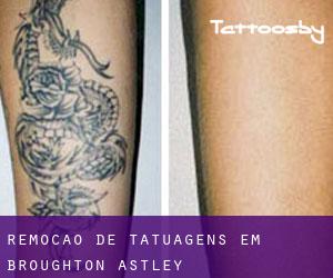 Remoção de tatuagens em Broughton Astley