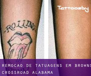 Remoção de tatuagens em Browns Crossroad (Alabama)