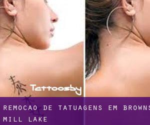 Remoção de tatuagens em Browns Mill Lake