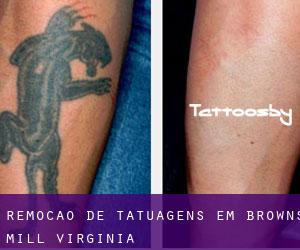 Remoção de tatuagens em Browns Mill (Virginia)