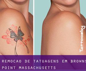 Remoção de tatuagens em Browns Point (Massachusetts)