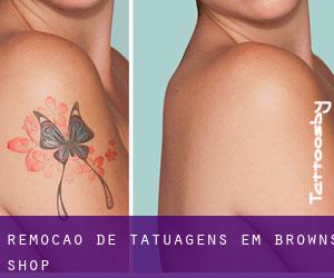 Remoção de tatuagens em Browns Shop