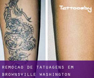 Remoção de tatuagens em Brownsville (Washington)