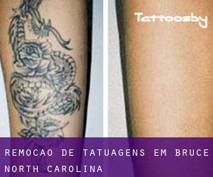 Remoção de tatuagens em Bruce (North Carolina)