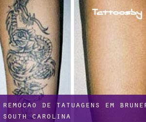 Remoção de tatuagens em Bruner (South Carolina)