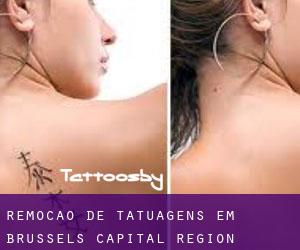 Remoção de tatuagens em Brussels Capital Region