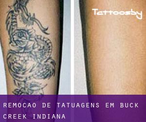 Remoção de tatuagens em Buck Creek (Indiana)
