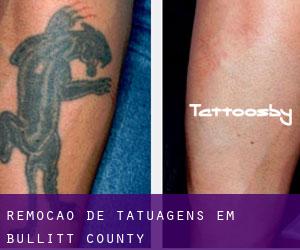 Remoção de tatuagens em Bullitt County
