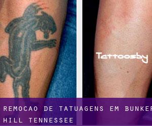 Remoção de tatuagens em Bunker Hill (Tennessee)