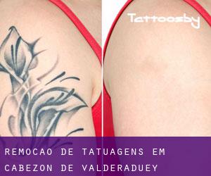 Remoção de tatuagens em Cabezón de Valderaduey