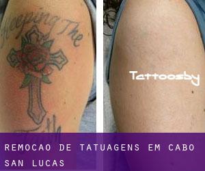 Remoção de tatuagens em Cabo San Lucas