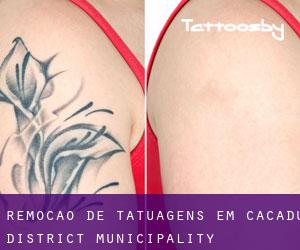 Remoção de tatuagens em Cacadu District Municipality