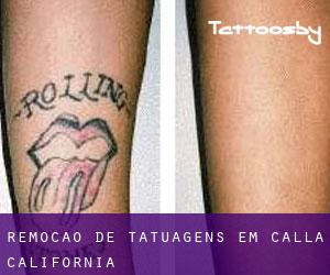 Remoção de tatuagens em Calla (California)