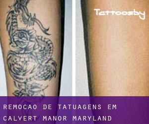 Remoção de tatuagens em Calvert Manor (Maryland)