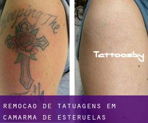 Remoção de tatuagens em Camarma de Esteruelas
