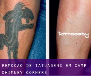 Remoção de tatuagens em Camp Chimney Corners