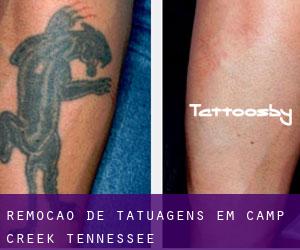 Remoção de tatuagens em Camp Creek (Tennessee)