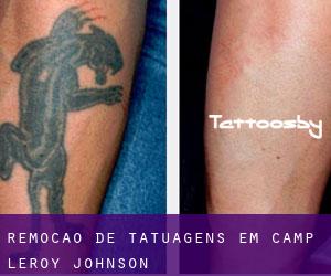 Remoção de tatuagens em Camp Leroy Johnson